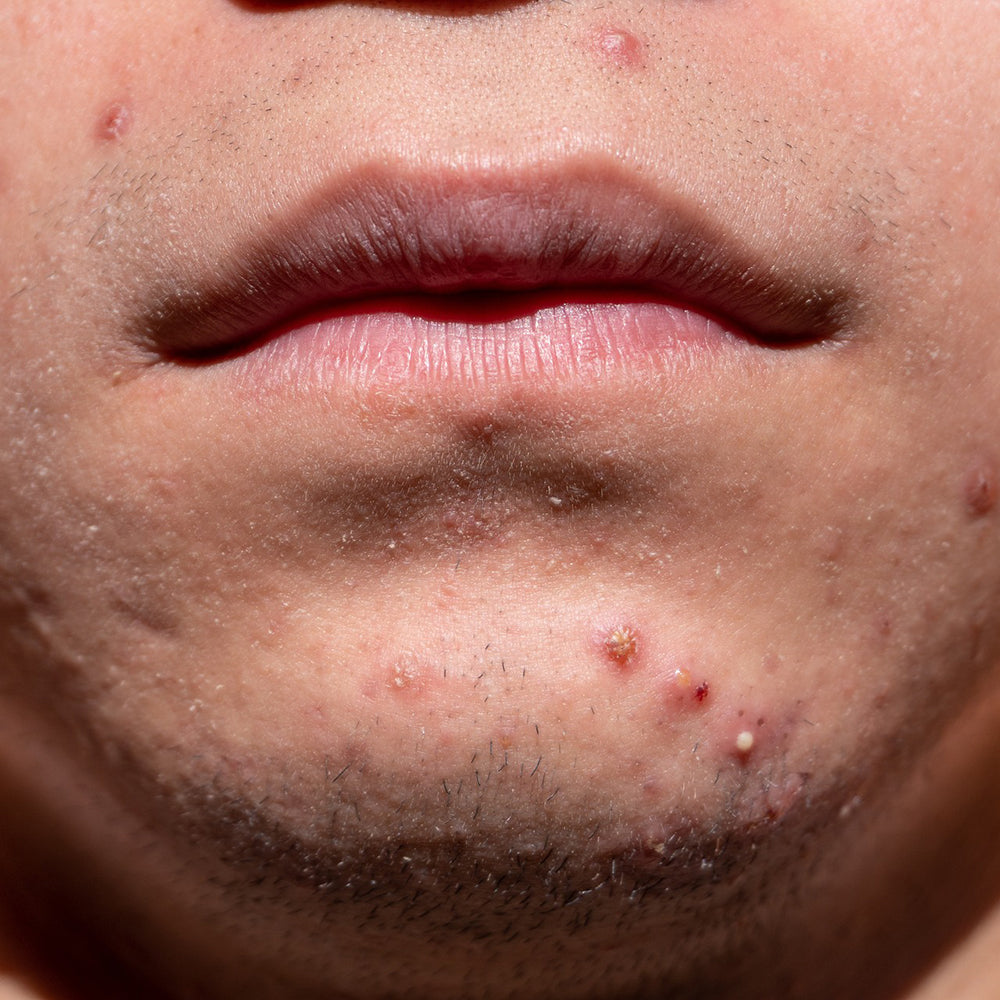 Acne em homens: causas e cuidados com a pele do rosto, costas e ombros