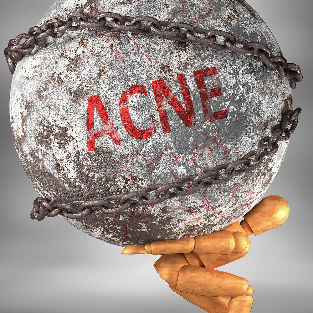 Acne e stress: como o stress afeta a pele com tendência a acne