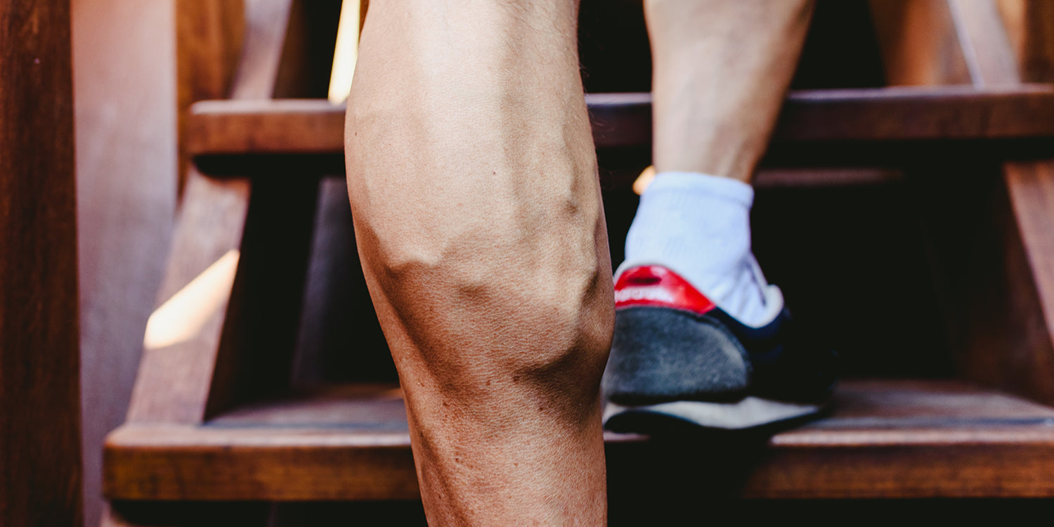varizes nas pernas — como o exercício físico pode afetá-las