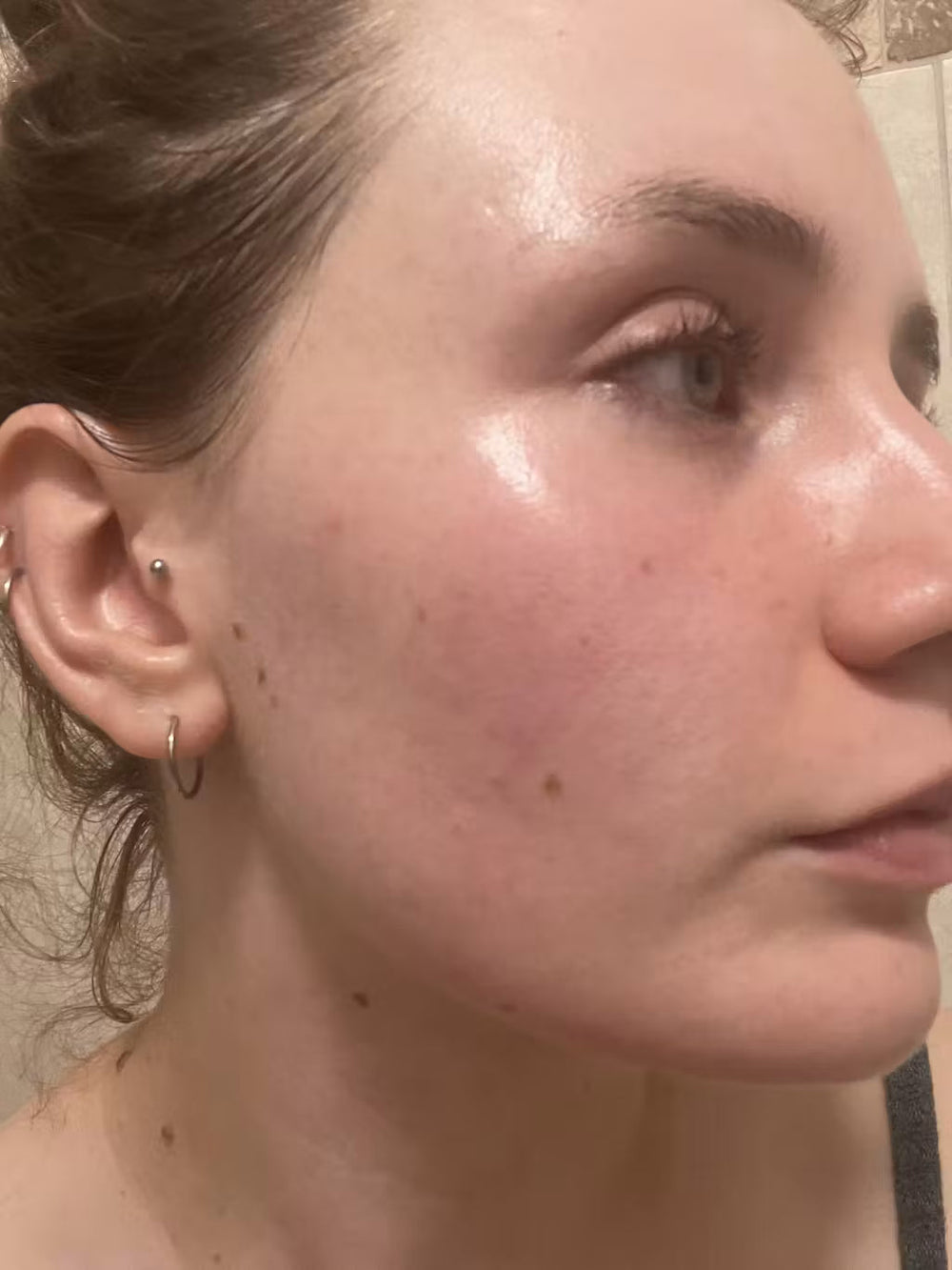 acne PT keep