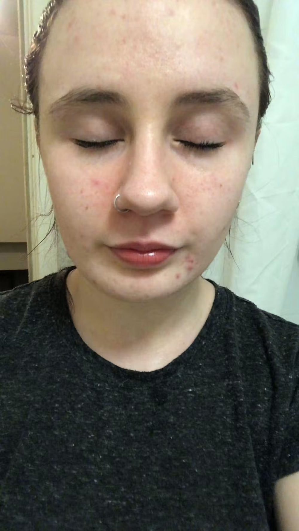 acne PT keep