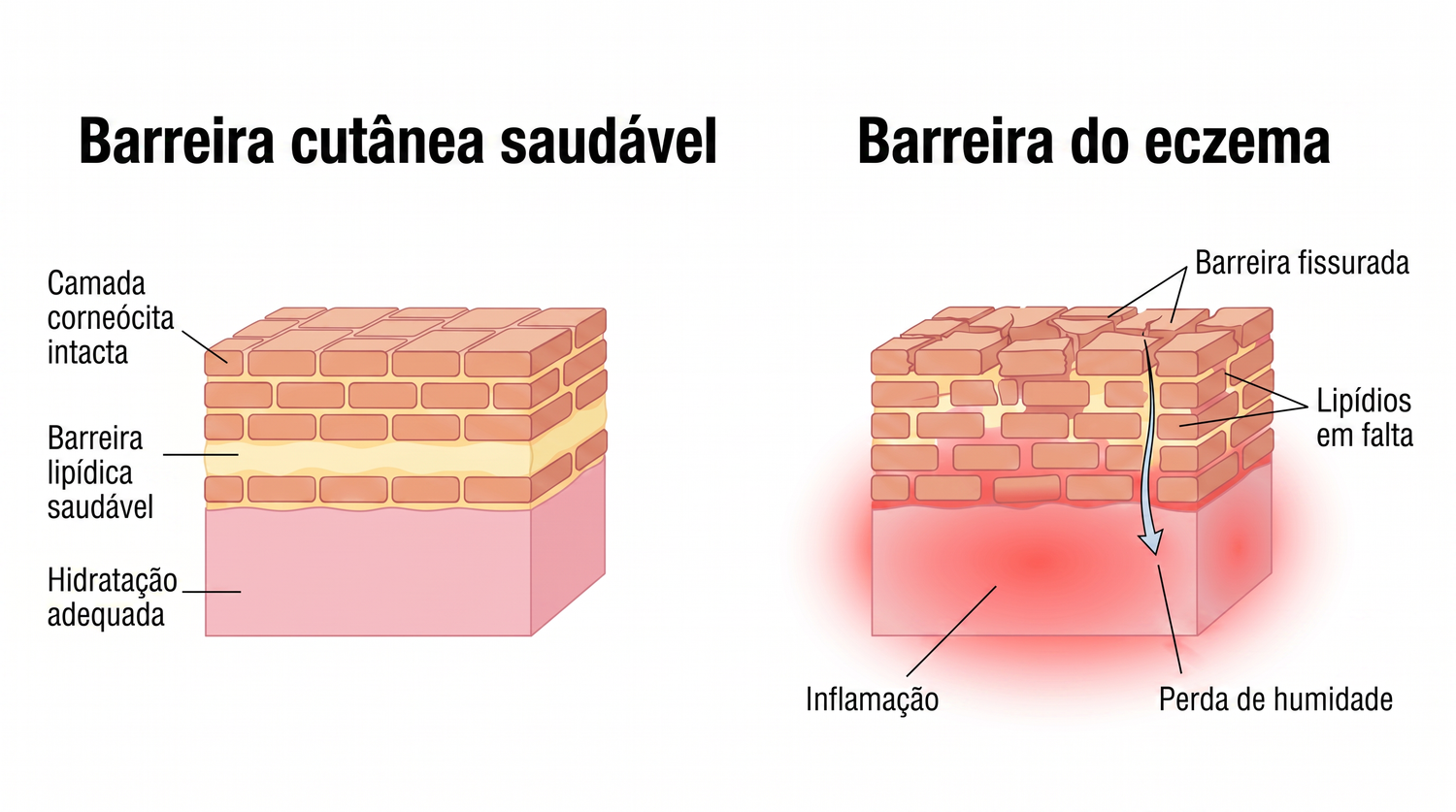eczema_PT_skin_barrier_v2.png