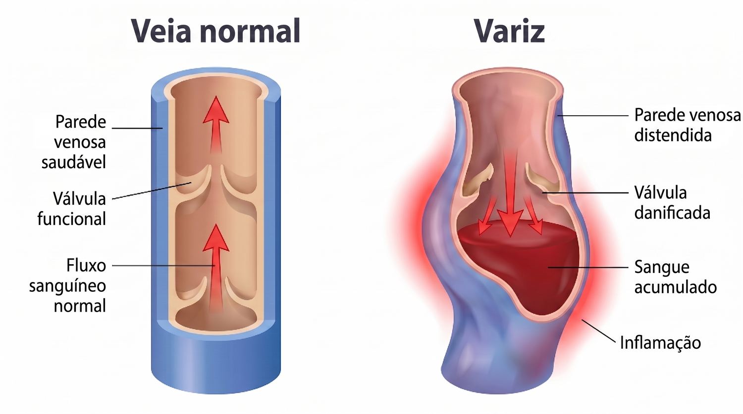 periodontis