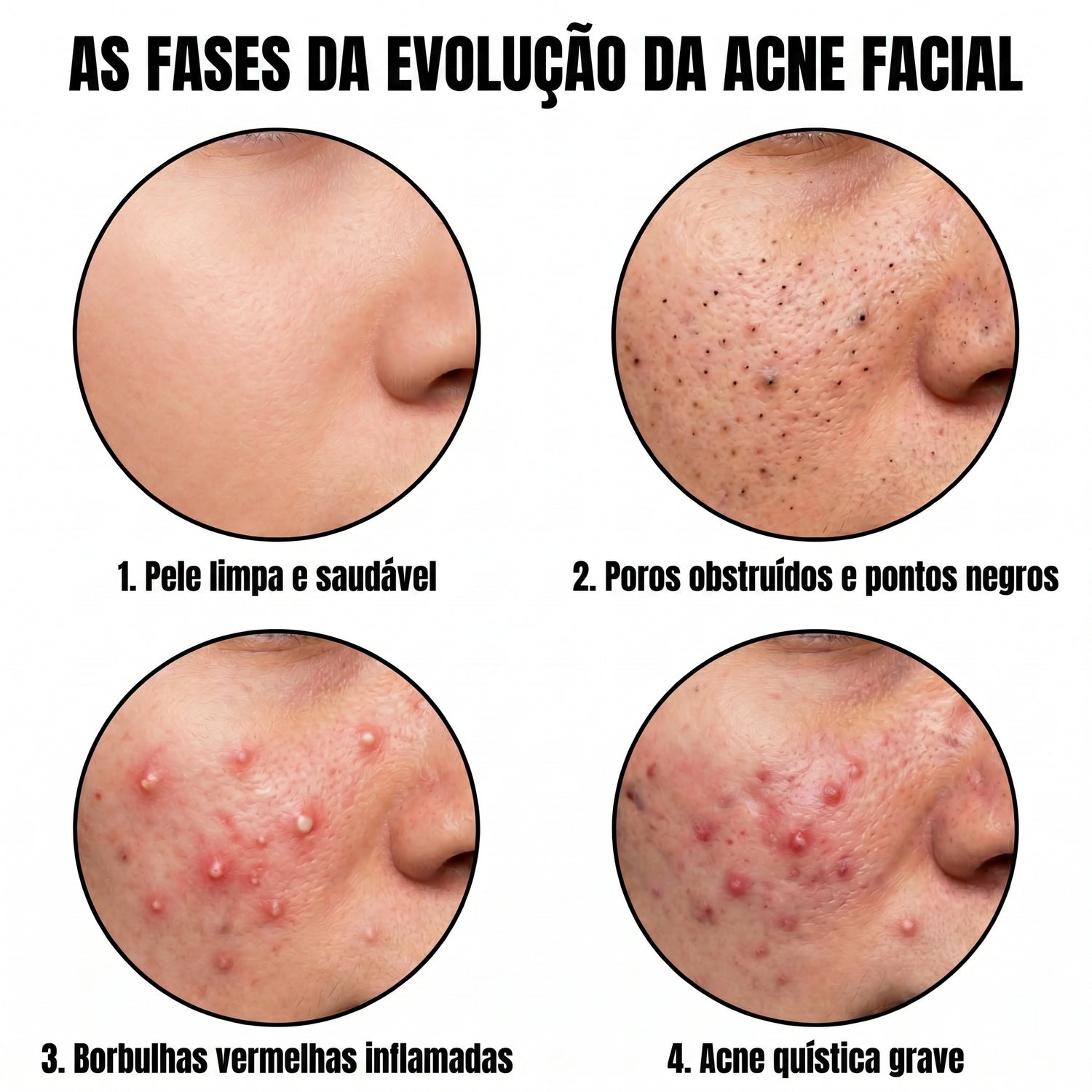 acne PT translated